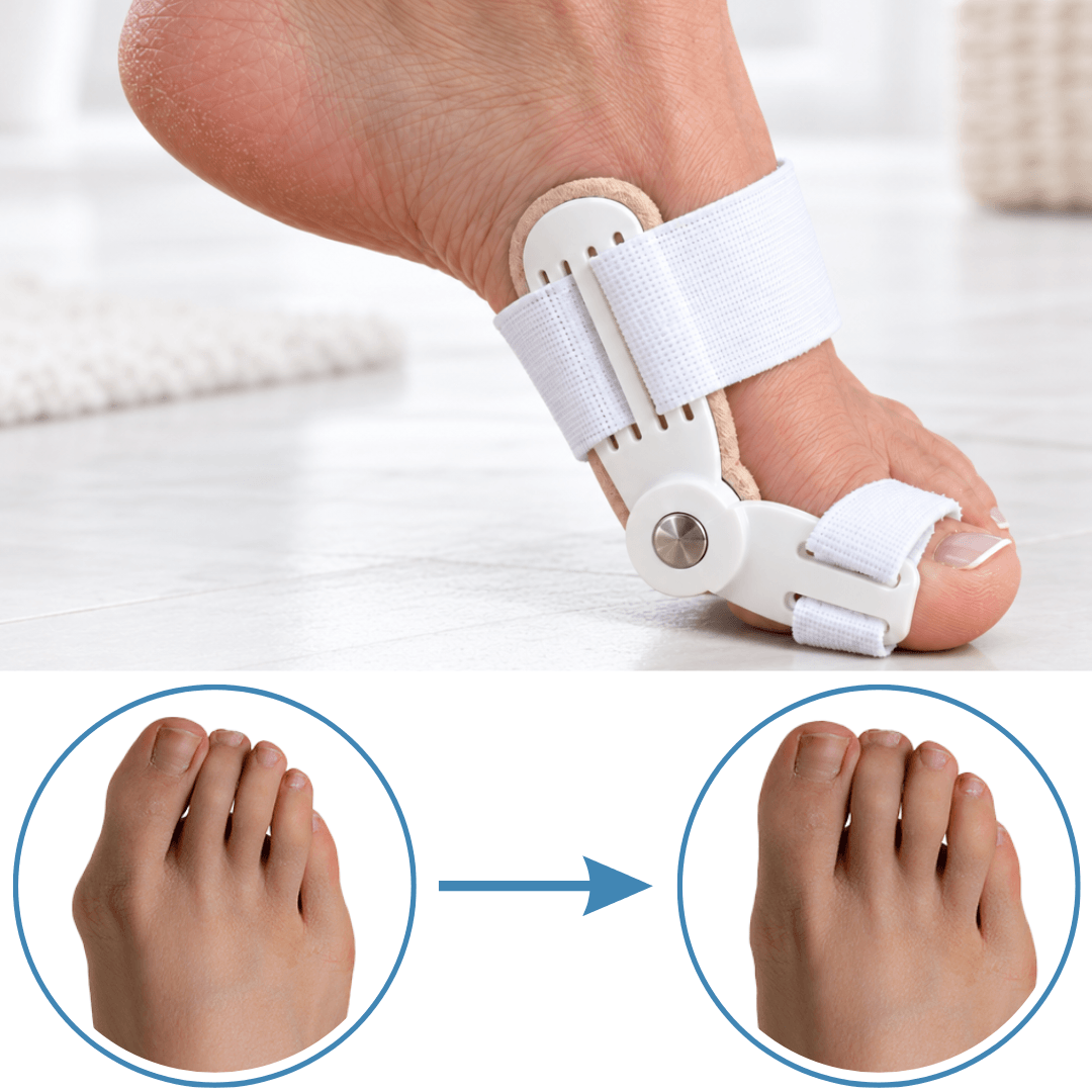 Foot wearing the Pedineo® corrector