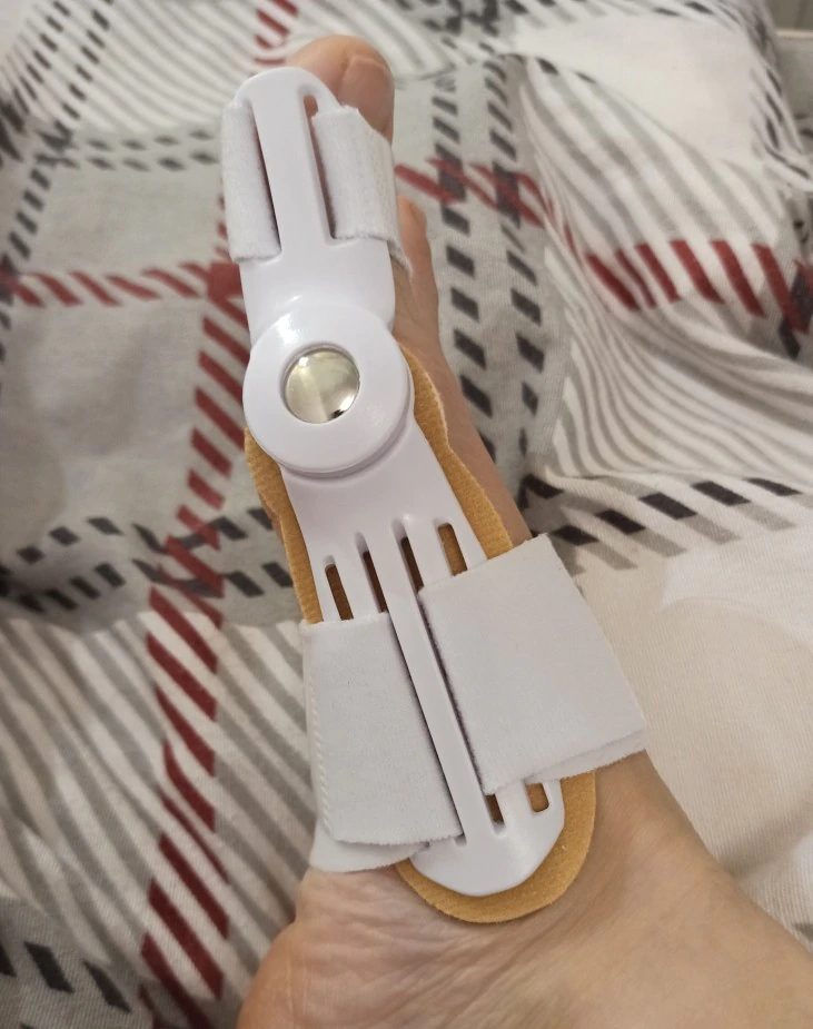 Hayley's foot with the Pedineo® corrector
