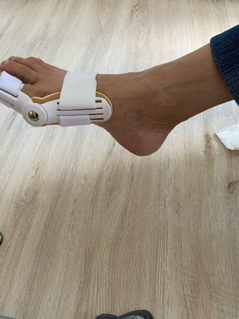 Michelle's foot with the Pedineo® corrector