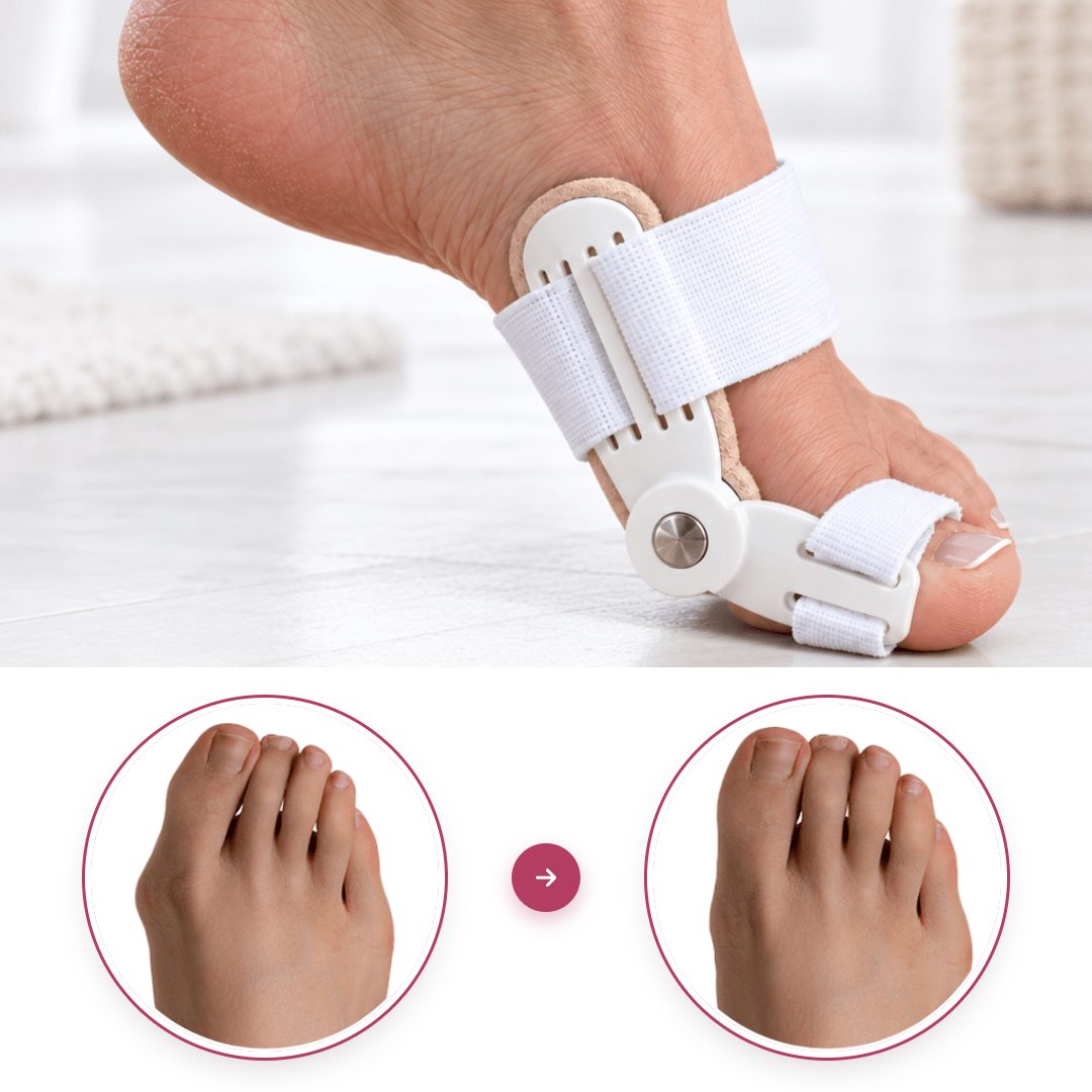 Foot wearing the Pedineo® corrector